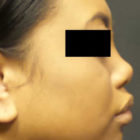 A Before and After photo of a Non-Surgical Nose Job by Dr. Craig Jonov in Bellevue, Kirkland, and Lynnwood.