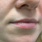 A Before and After photo of Restylane Silk Filler at The Gallery of Cosmetic Surgery in Bellevue, Kirkland, and Lynnwood.