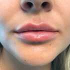 An After Photo of Restylane Kysse Lip Filler in Bellevue, Kirkland, and Lynnwood