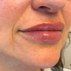 An After Photo of Lip Filler in Bellevue, Kirkland, and Lynnwood