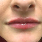 An After Photo of Lip Filler in Bellevue, Kirkland, and Lynnwood