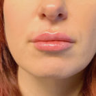 An After Photo of Restylane L Lip Filler In Bellevue, Kirkland, and Lynnwood