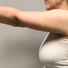 An After Photo of an Arm Lift Plastic Surgery by Dr. Craig Jonov in Bellevue, Kirkland, and Lynnwood