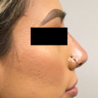 An After Photo of a Non-Surgical Rhinoplasty by Dr. Craig Jonov in Bellevue, Kirkland, and Lynnwood