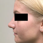 An After Photo of a Rhinoplasty Plastic Surgery by Dr. Craig Jonov in Bellevue, Kirkland, and Lynnwood
