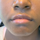 An After Photo of Lip Filler in Bellevue, Kirkland, and Lynnwood