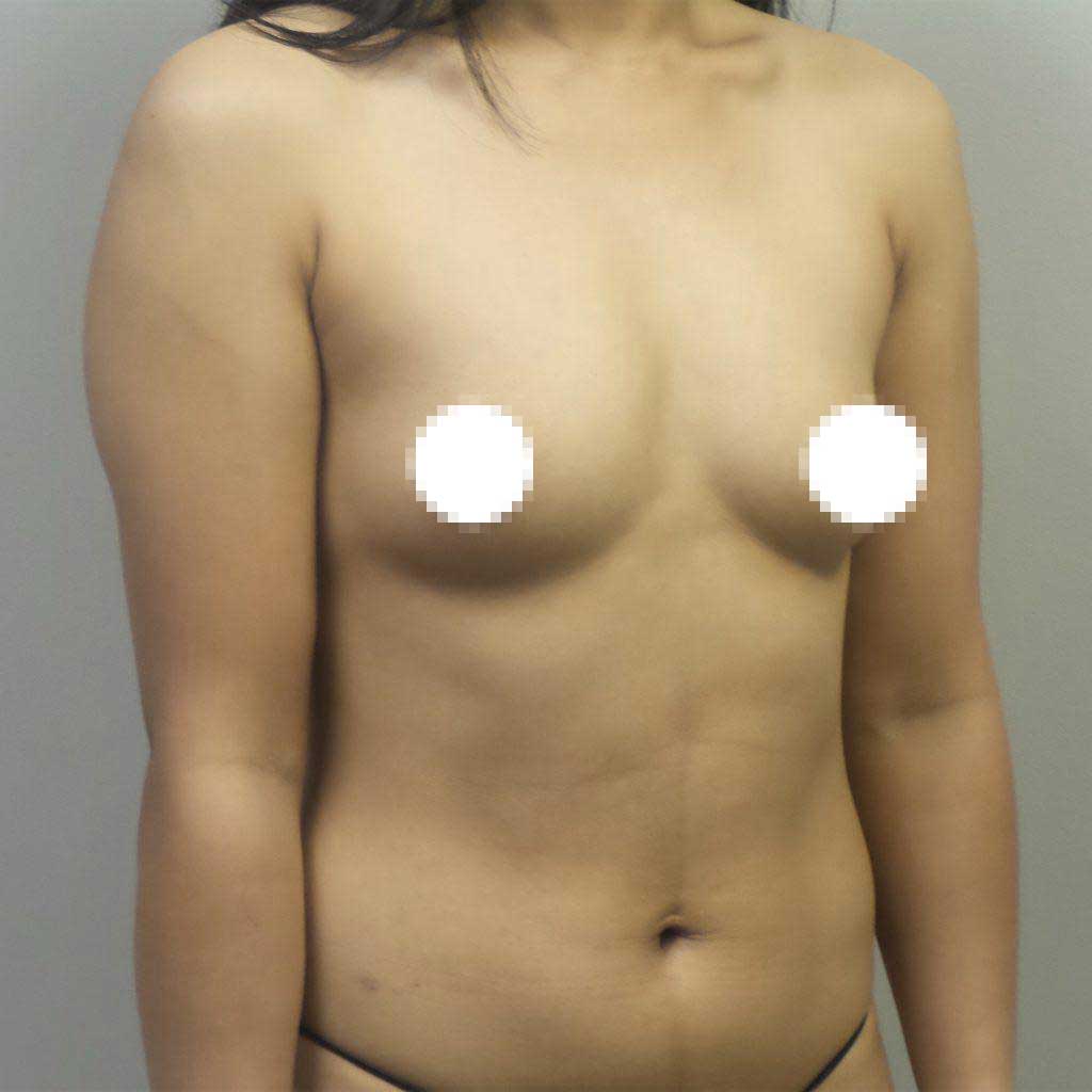 A Before Photo of a Breast Augmentation Plastic Surgery by Dr. Craig Jonov in Bellevue, Kirkland, and Lynnwood