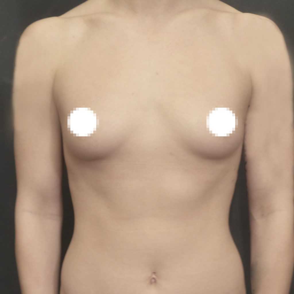 A Before Photo of A Breast Augmentation Plastic Surgery by Dr. Craig Jonov in Bellevue, Kirkland, and Lynnwood