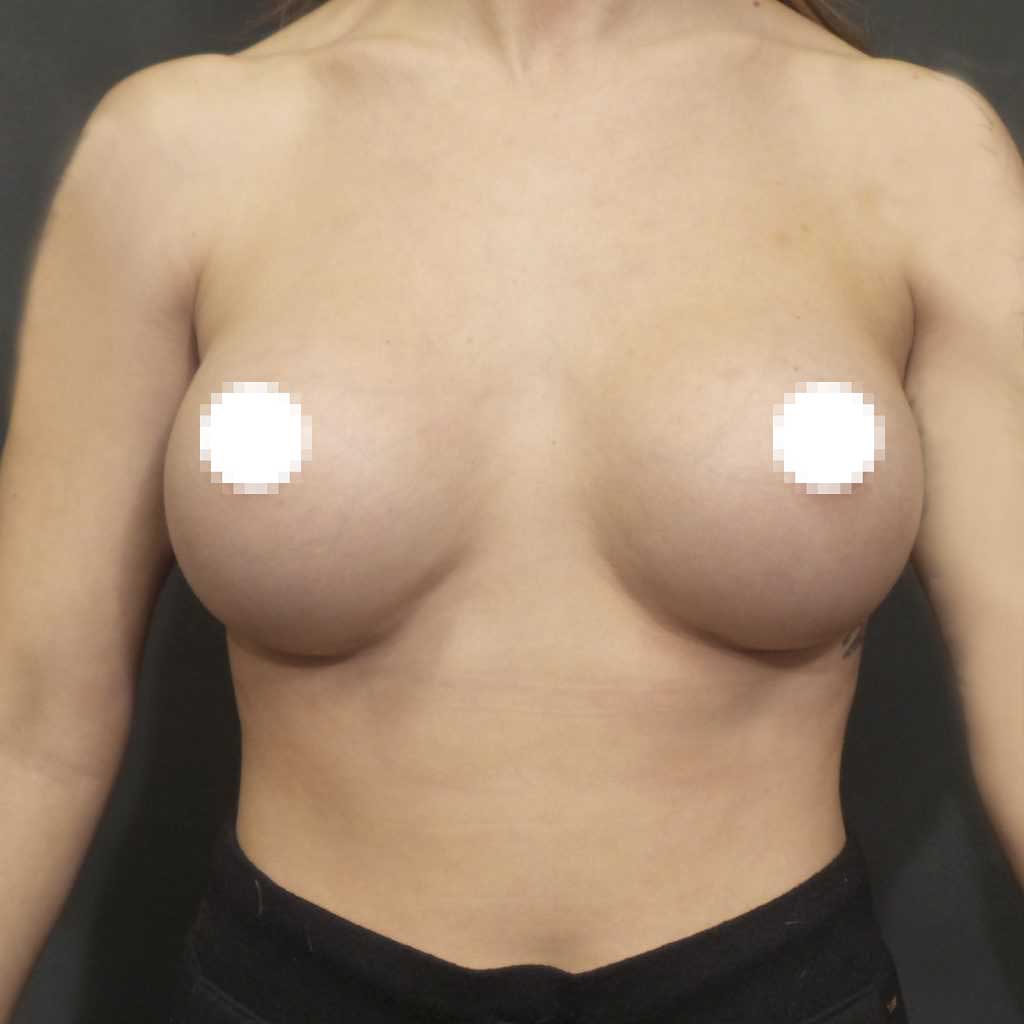An After Photo of A Breast Augmentation Plastic Surgery by Dr. Craig Jonov in Bellevue, Kirkland, and Lynnwood