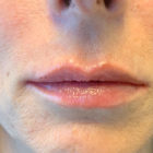 An Photo of Lip Filler Injections in Bellevue, Kirkland, and Lynnwood