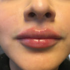 An After Photo of Restylane Defyne Lip Filler in Bellevue, Kirkland, and Lynnwood