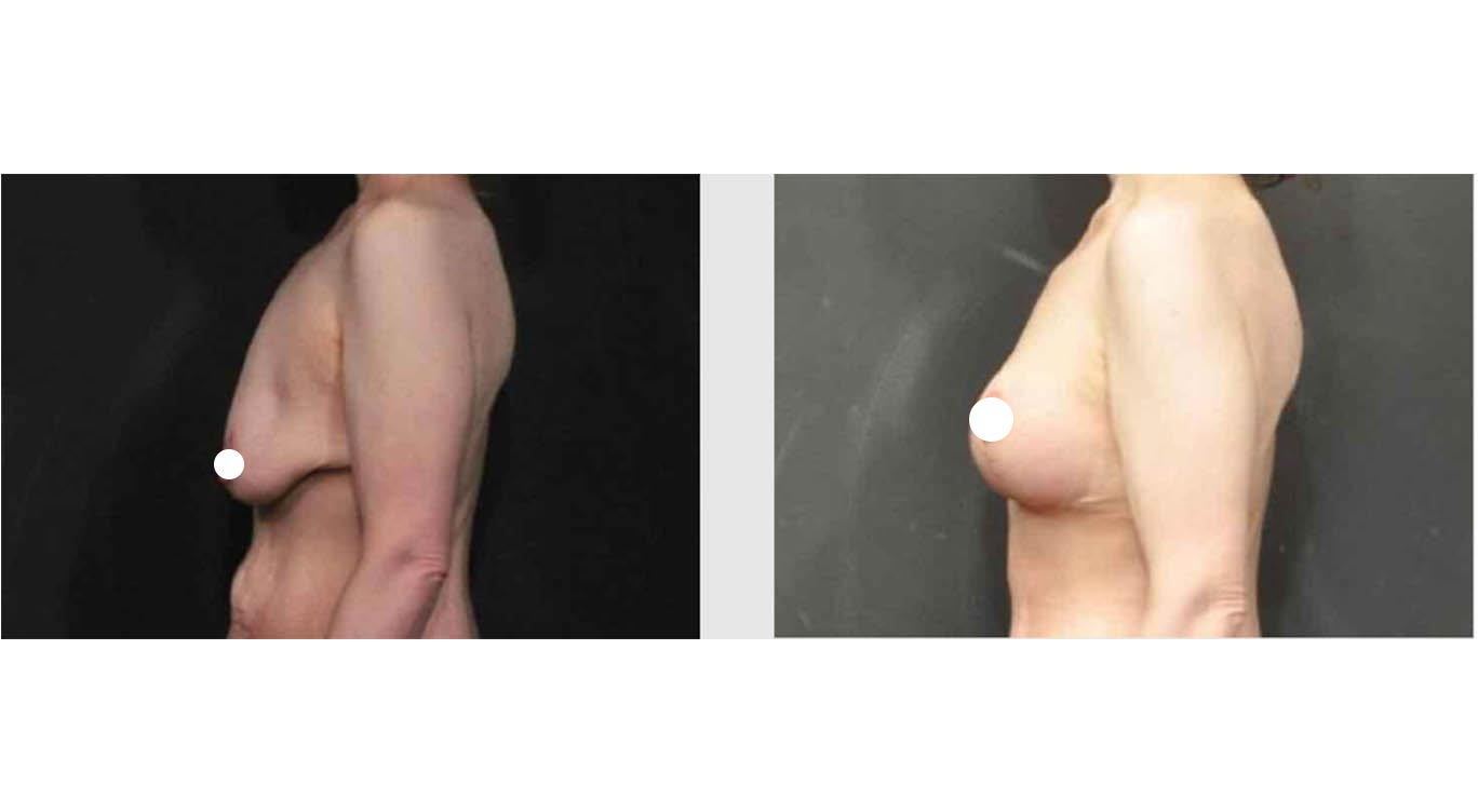 A Before & After Photo of a Breast Lift Plastic Surgery by Dr. Craig Jonov in Bellevue, Kirkland, Lynnwood