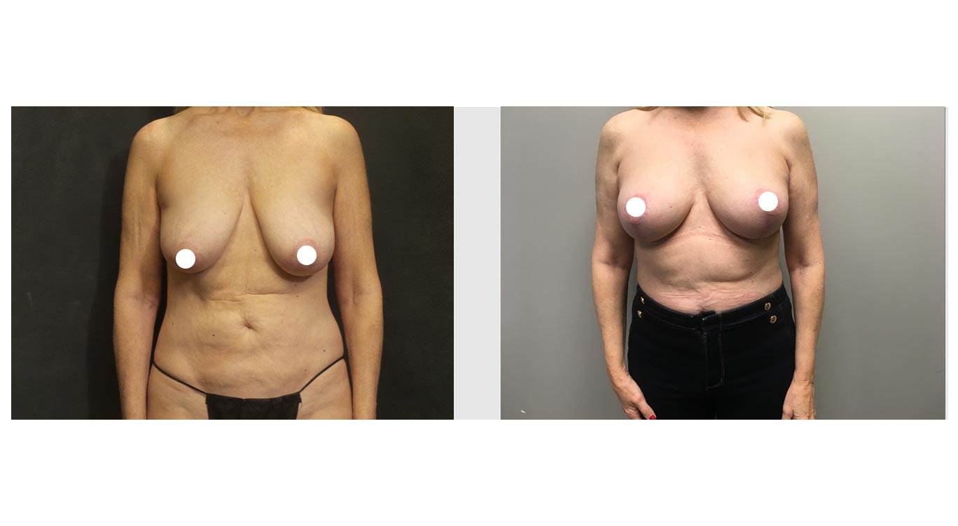 A Before and After Photo of a Auto Breast Augmentation Plastic Surgery by Dr. Craig Jonov in Bellevue, Kirkland, and Lynnwood