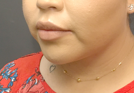 An After Photo of Submental Liposuction Plastic Surgery by Dr. Craig Jonov in Bellevue and Kirkland