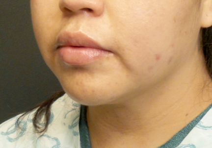 A Before Photo of Submental Liposuction Plastic Surgery by Dr. Craig Jonov in Bellevue and Kirkland