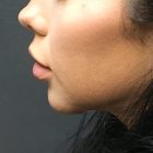 An After Photo of a Chin Augmentation Plastic Surgery by Dr. Craig Jonov in Bellevue and Kirkland