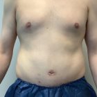 An After Photo of a Male Tummy Tuck Plastic Surgery by Dr. Craig Jonov in Bellevue and Kirkland