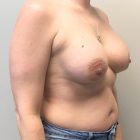 An After Photo of a Breast Augmentation Plastic Surgery by Dr. Craig Jonov in Bellevue and Kirkland