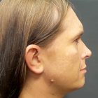 An After Photo Of A Rhinoplasty Plastic Surgery by Dr. Craig Jonov in Bellevue and Kirkland