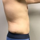 An After Photo of a Male Tummy Tuck Plastic Surgery by Dr. Craig Jonov in Bellevue and Kirkland