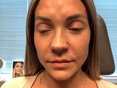 An After Photo Of Nasolabial Fold Filler in Bellevue and Kirkland