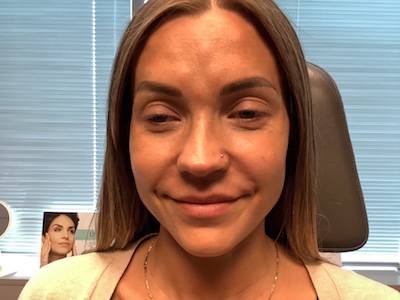 A Before Photo Of Nasolabial Fold Filler in Bellevue and Kirkland
