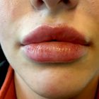 An After Photo of Restylane Defyne Lip Filler in Bellevue and Kirkland