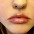 An After Photo of Juvederm Lip Filler In Bellevue and Kirkland