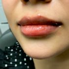 An After Photo of Lip Filler And Chin Filler In Bellevue and Kirkland