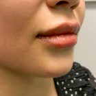 An After Photo of Lip Filler And Chin Filler In Bellevue and Kirkland