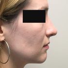 A Before Photo of a Rhinoplasty Plastic Surgery by Dr. Craig Jonov in Bellevue and Kirkland
