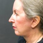 An After Photo of a Facelift Plastic Surgery by Dr. Craig Jonov in Bellevue and Kirkland