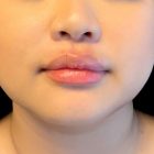 An After Photo of Restylane L Lip Filler in Bellevue and Kirkland