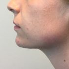 An After Photo of Chin Fillers in Bellevue and Kirkland