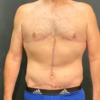 An After Photo of a Fleur de Lis Tummy Tuck Plastic Surgery by Dr. Craig Jonov in Bellevue and Kirkland