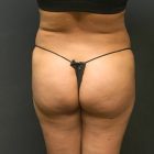 An After Photo of a Brazilian Butt Lift Plastic Surgery by Dr. Craig Jonov in Bellevue and Kirkland