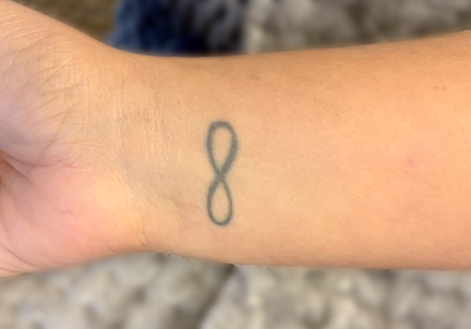 A Before Photo of Laser Tattoo Removal in Bellevue and Kirkland