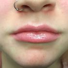 An After Photo of Restylane Defyne Lip Filler in Bellevue and Kirkland