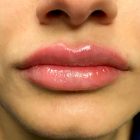 An After Photo of Juvederm Lip Fillers In Bellevue and Kirkland