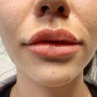 An After Photo of Restylane Defyne Lip Filler in Bellevue and Kirkland