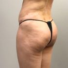 An After Photo of a Brazilian Butt Lift Plastic Surgery by Dr. Craig Jonov in Bellevue and Kirkland