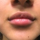 An After Photo of Restylane Defyne Lip Filler In Bellevue and Kirkland