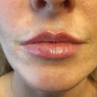 An After Photo of Restylane Kysse Lip Filler In Bellevue and Kirkland