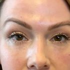 An After Photo of Under Eye Filler in Bellevue and Kirkland