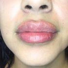 An After Photo of Restylane Kysse Lip Filler in Bellevue and Kirkland