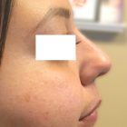 An After Photo of a Non-Surgical Nose Job In Bellevue and Kirkland