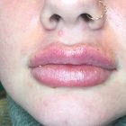 An After Photo of Restylane Kysse Lip Filler In Bellevue and Kirkland