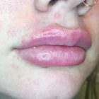 An After Photo of Restylane Kysse Lip Filler In Bellevue and Kirkland