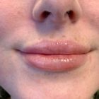 An After Photo of Restylane Kysse Lip Filler in Seattle and Tacoma