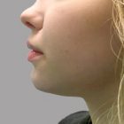 An After Photo of Chin Filler in Bellevue and Kirkland